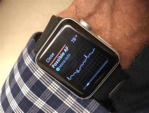 2019 clone apple watch with ecg|apple watch and kardia ecg.